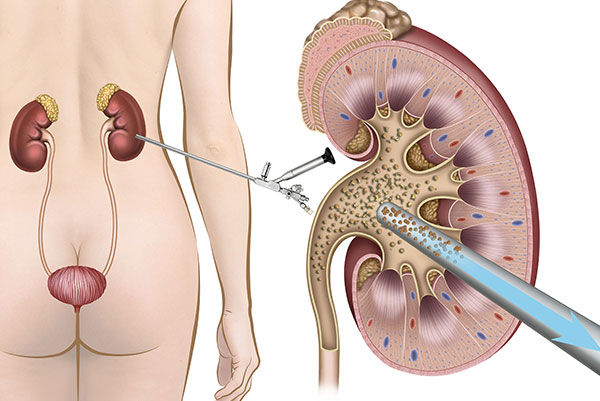 Les calculs rénaux - Centre d'Urologie Lyon Ouest