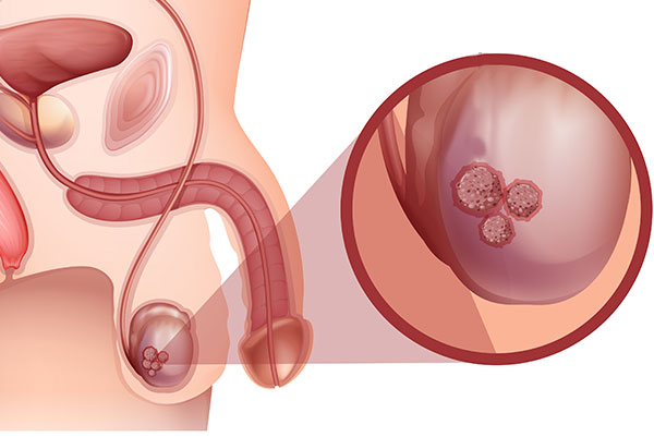 Le cancer du testicule - Centre d'Urologie Lyon Ouest