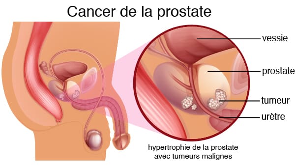 Le cancer de la prostate expliqué en vidéo par le Dr CHAVRIER Bruno